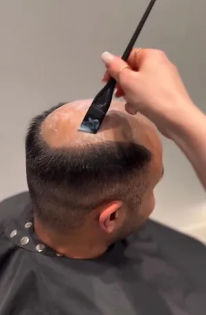 حلول الصلع ومعالج الشعر تركيب شبكيات وشعر بديل طبيعي 100%