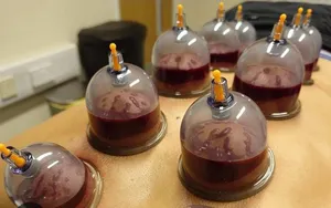 Best Cupping Therapy (Hijama) Services - Clinic & Home Service in Muscat