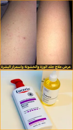 عرض خاص لعلاج جلد الوزة وتفتيح وتوحيد لون البشرة