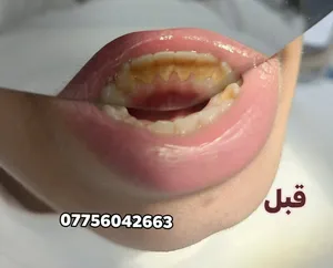 عيادات تجميل الاسنان مجاناً