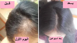 لعلاج الصلع والفراغات والثعلبة والتساقط نهائيااا