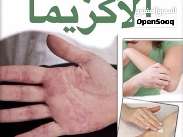 خلطة للتحلص من الاكزيما