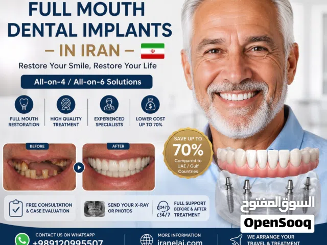 استعادة الأسنان بالكامل بزراعة الأسنان في إيران