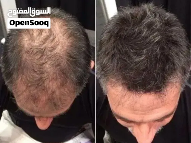 تونيك إكسونيك (Exonic) لمنع تساقط الشعر وتحفيز إعادة نموه