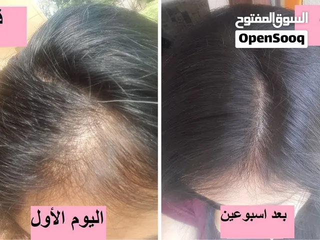لعلاج الصلع والفراغات والثعلبة والتساقط نهائيااا